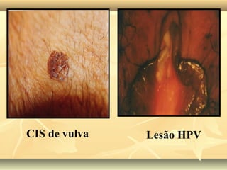 CIS de vulva

Lesão HPV

 
