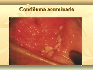 Condiloma acuminado

 