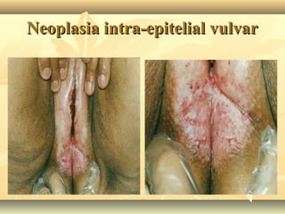 Neoplasia intra-epitelial vulvar

 