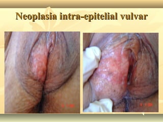 Neoplasia intra-epitelial vulvar

 