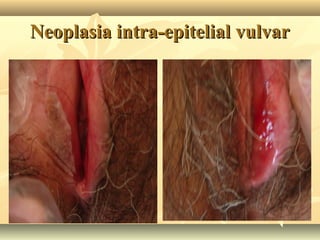 Neoplasia intra-epitelial vulvar

 