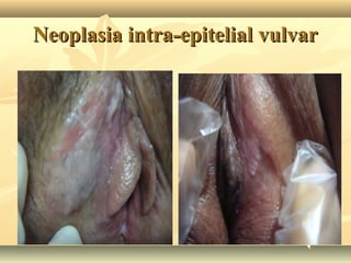 Neoplasia intra-epitelial vulvar

 