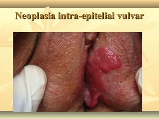 Neoplasia intra-epitelial vulvar

 