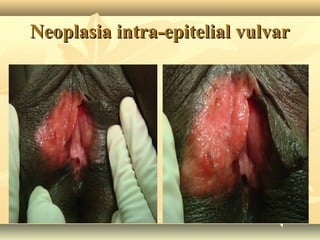 Neoplasia intra-epitelial vulvar

 