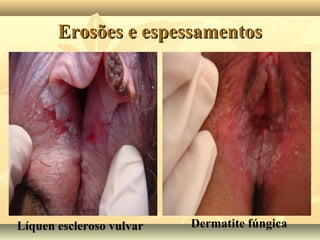 Erosões e espessamentos

Líquen escleroso vulvar

Dermatite fúngica

 