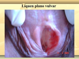 Líquen plano vulvar

 