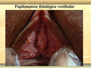 Papilomatose fisiológica vestibular

 