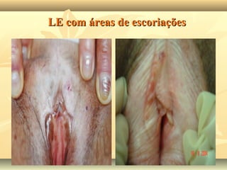 LE com áreas de escoriações

 