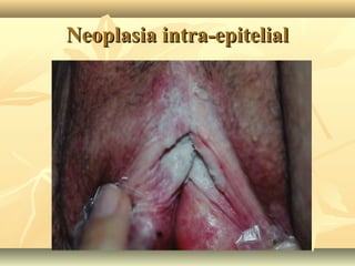 Neoplasia intra-epitelial

 