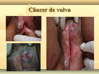 Câncer de vulva

 