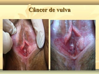 Câncer de vulva

 