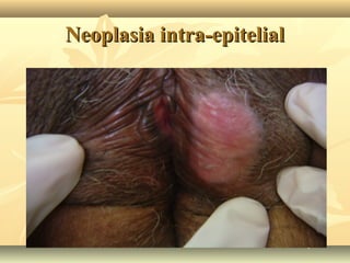 Neoplasia intra-epitelial

 