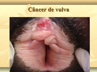 Câncer de vulva

 