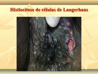 Histiocitose de células de Langerhans

 