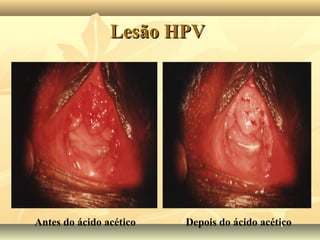 Lesão HPV

Antes do ácido acético

Depois do ácido acético

 