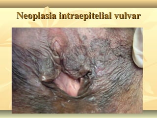Neoplasia intraepitelial vulvar

 