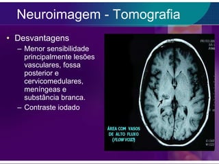 Neuroimagem - Tomografia Desvantagens Menor sensibilidade principalmente lesões vasculares, fossa posterior e cervicomedulares, meníngeas e substância branca. Contraste iodado 