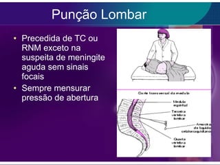 Punção Lombar Precedida de TC ou RNM exceto na suspeita de meningite aguda sem sinais focais Sempre mensurar pressão de abertura 