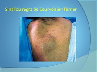 Sinal ou regra de Courvoisier-Terrier 
 