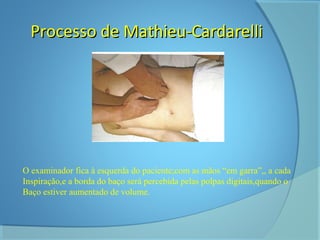 PPrroocceessssoo ddee MMaatthhiieeuu--CCaarrddaarreellllii 
O examinador fica à esquerda do paciente;com as mãos “em garra”,, a cada 
Inspiração,e a borda do baço será percebida pelas polpas digitais,quando o 
Baço estiver aumentado de volume. 
 
