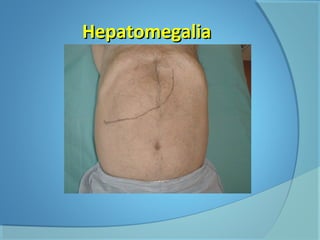 HHeeppaattoommeeggaalliiaa 
 