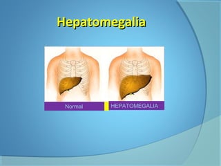 HHeeppaattoommeeggaalliiaa 
Normal HEPATOMEGALIA 
 
