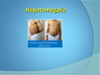 HHeeppaattoommeeggaalliiaa 
Hepatomegalia/Distensão 
abdominal 
 