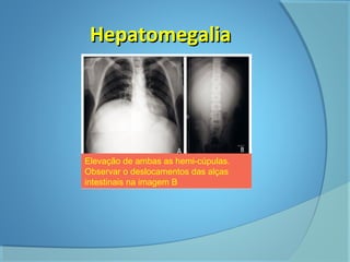 HHeeppaattoommeeggaalliiaa 
Elevação de ambas as hemi-cúpulas. 
Observar o deslocamentos das alças 
intestinais na imagem B 
 