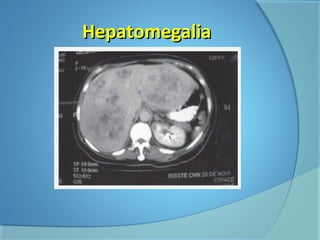 HHeeppaattoommeeggaalliiaa 
 