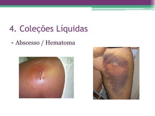 4. Coleções Líquidas
• Abscesso / Hematoma
 