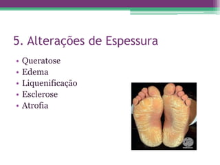 5. Alterações de Espessura
•   Queratose
•   Edema
•   Liquenificação
•   Esclerose
•   Atrofia
 