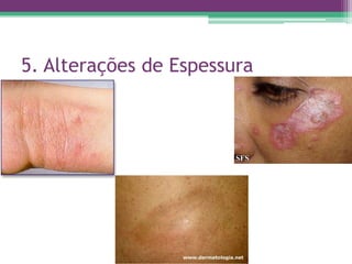 5. Alterações de Espessura
 