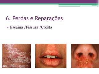 6. Perdas e Reparações
• Escama /Fissura /Crosta
 