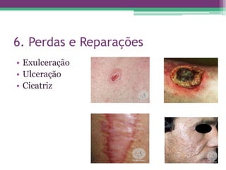 6. Perdas e Reparações
• Exulceração
• Ulceração
• Cicatriz
 