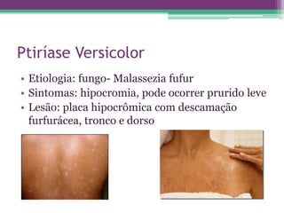 Ptiríase Versicolor
• Etiologia: fungo- Malassezia fufur
• Sintomas: hipocromia, pode ocorrer prurido leve
• Lesão: placa hipocrômica com descamação
  furfurácea, tronco e dorso
 