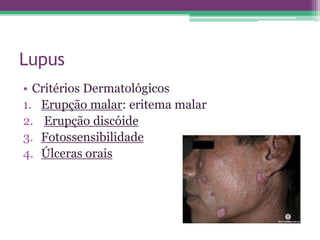 Lupus
• Critérios Dermatológicos
1. Erupção malar: eritema malar
2. Erupção discóide
3. Fotossensibilidade
4. Úlceras orais
 