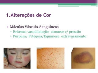 1.Alterações de Cor

• Máculas Vásculo-Sanguíneas
 ▫ Eritema: vasodilatação- esmaece c/ pressão
 ▫ Púrpura/ Petéquia/Equimose: extravasamento
 