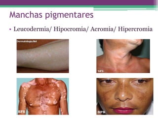 Manchas pigmentares
• Leucodermia/ Hipocromia/ Acromia/ Hipercromia
 