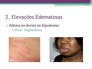 2. Elevações Edematosas
• Edema na derme ou hipoderme
 ▫ Urtica/ Angioedema
 