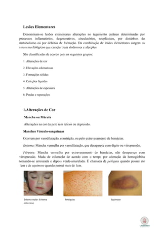Lesões Elementares
   Denominam-se lesões elementares alterações no tegumento cutâneo determinadas por
processos inflamatórios, degenerativos, circulatórios, neoplásicos, por distúrbios do
metabolismo ou por defeitos de formação. Da combinação de lesões elementares surgem os
sinais morfológicos que caracterizam síndromes e afecções.

  São classificadas de acordo com os seguintes grupos:

  1. Alterações de cor

  2. Elevações edematosas

  3. Formações sólidas

  4. Coleções líquidas

  5. Alterações de espessura

  6. Perdas e reparações




  1.Alterações de Cor
   Mancha ou Mácula

   Alterações na cor da pele sem relevo ou depressão.

  Manchas Vásculo-sanguíneas

  Ocorrem por vasodilatação, constrição, ou pelo extravasamento de hemácias.

  Eritema: Mancha vermelha por vasodilatação, que desaparece com digito ou vitropressão.

   Púrpura: Mancha vermelha por extravasamento de hemácias, não desaparece com
vitropressão. Muda de coloração de acordo com o tempo por alteração da hemoglobina
tornando-se arroxeada e depois verde-amarelada. É chamada de petéquia quando possui até
1cm e de equimose quando possui mais de 1cm.




   Eritema malar: Eritema        Petéquias                        Equimose
   infeccioso
 