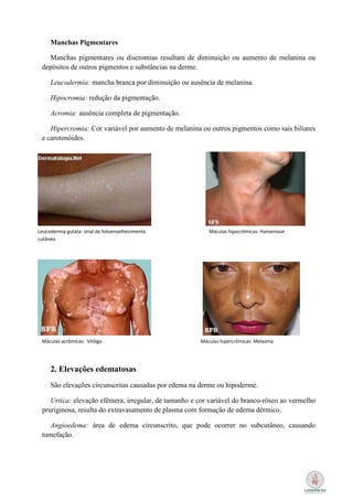 Manchas Pigmentares

   Manchas pigmentares ou discromias resultam de diminuição ou aumento de melanina ou
 depósitos de outros pigmentos e substâncias na derme.

     Leucodermia: mancha branca por diminuição ou ausência de melanina.

     Hipocromia: redução da pigmentação.

     Acromia: ausência completa de pigmentação.

    Hipercromia: Cor variável por aumento de melanina ou outros pigmentos como sais biliares
 e carotenóides.




Leucodermia gutata: sinal de fotoenvelhecimento          Máculas hipocrômicas: Hanseníase
cutâneo




 Máculas acrômicas: Vitiligo                          Máculas hipercrômicas: Melasma




     2. Elevações edematosas
     São elevações circunscritas causadas por edema na derme ou hipoderme.

    Urtica: elevação efêmera, irregular, de tamanho e cor variável do branco-róseo ao vermelho
 pruriginosa, resulta do extravasamento de plasma com formação de edema dérmico.

    Angioedema: área de edema circunscrito, que pode ocorrer no subcutâneo, causando
 tumefação.
 