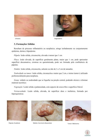Urticária                                             Angioedema


        3. Formações Sólidas
       Resultam de processo inflamatório ou neoplásico, atinge isoladamente ou conjuntamente
    epiderme, derme e hipoderme.

        Pápula: lesão sólida, circunscrita, elevada e menor que 1 cm.

       Placa: lesão elevada, de superfície geralmente plana, maior que 1 cm, pode apresentar
    superfície descamativa, crostosa ou queratinizada, pode ser formada pela confluência de
    pápulas.

        Nódulo: lesão sólida, circunscrita, saliente ou não de 1 a 3 cm de tamanho.

       Nodosidade ou tumor: lesão sólida, circunscrita e maior que 3 cm, o termo tumor é utilizado
    preferencialmente para neoplasia.

      Goma: nódulo ou nodosidade que se liquefaz na porção central, podendo ulcerar e eliminar
    material necrótico.

        Vegetação: Lesão sólida e pedunculada, com aspecto de couve-flor e superfície friável.

       Verrucosidade: Lesão sólida, elevada, de superfície dura e inelástica, formada por
    hiperqueratose.




Pápulas: Escabiose              Nódulo: Carcinoma Basocelular                Tumor: Melanoma
 