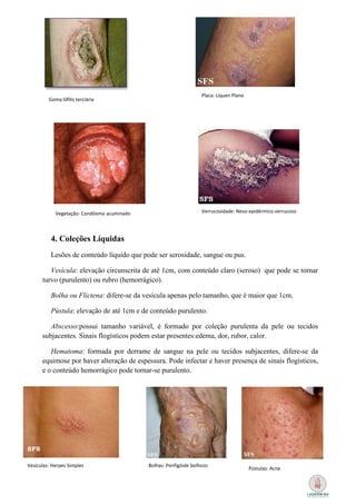 Placa: Líquen Plano
         Goma:Sífilis terciária




            Vegetação: Condiloma acuminado                          Verrucosidade: Nevo epidérmico verrucoso




          4. Coleções Líquidas
          Lesões de conteúdo líquido que pode ser serosidade, sangue ou pus.

         Vesícula: elevação circunscrita de até 1cm, com conteúdo claro (seroso) que pode se tornar
      turvo (purulento) ou rubro (hemorrágico).

          Bolha ou Flictena: difere-se da vesícula apenas pelo tamanho, que é maior que 1cm.

          Pústula: elevação de até 1cm e de conteúdo purulento.

         Abscesso:possui tamanho variável, é formado por coleção purulenta da pele ou tecidos
      subjacentes. Sinais flogísticos podem estar presentes:edema, dor, rubor, calor.

         Hematoma: formada por derrame de sangue na pele ou tecidos subjacentes, difere-se da
      equimose por haver alteração de espessura. Pode infectar e haver presença de sinais flogísticos,
      e o conteúdo hemorrágico pode tornar-se purulento.




Vesículas: Herpes Simples                    Bolhas: Penfigóide bolhoso
                                                                                          Pústulas: Acne
 