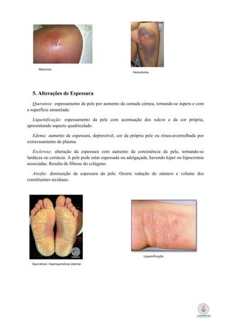 Abscesso
                                                       Hematoma




  5. Alterações de Espessura
   Queratose: espessamento da pele por aumento da camada córnea, tornando-se áspera e com
a superfície amarelada.

   Liquenificação: espessamento da pele com acentuação dos sulcos e da cor própria,
apresentando aspecto quadriculado.

   Edema: aumento de espessura, depressível, cor da própria pele ou rósea-avermelhada por
extravasamento de plasma.

   Esclerose: alteração da espessura com aumento da consistência da pele, tornando-se
lardácea ou coriácea. A pele pode estar espessada ou adelgaçada, havendo hiper ou hipocromia
associadas. Resulta de fibrose do colágeno.

  Atrofia: diminuição da espessura da pele. Ocorre redução do número e volume dos
constituintes teciduais.




                                                            Liquenificação

  Queratose: hiperqueratose plantar
 