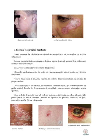 Esclerose: Esclerodermia                          Atrofia: Lupus Discóide Crônico




  6. Perdas e Reparações Teciduais
   Lesões oriundas da eliminação ou destruição patológicas e de reparações em tecidos
subcutâneos.

   Escama: massa furfurácea, micácea ou foliácea que se desprende as superfície cutânea por
alteração de queratinização.

  Exulceração: perda superficial somente de epiderme.

   Ulceração: perda circunscrita de epiderme e derme, podendo atingir hipoderme e tecidos
subjacentes.

   Fissura: perda linear da epiderme e derme, no contorno de orifícios naturais ou em áreas de
pregas e dobras.

   Crosta: concreção de cor amarela, esverdeada ou vermelha escura, que se forma em área de
perda tecidual. Resulta do dessecamento da serosidade, pus ou sangue misturado a restos
epiteliais.

   Cicatriz: lesão de aspecto variável, pode ser saliente ou deprimida, móvel ou aderente. Não
possui poros ou anexos cutâneos. Resulta da reparação de processo destrutivo da pele,
associado a atrofia, fibrose e discromia.




                                                                                   Ulceração: em perna, origem arterial

Escamas: Psoríase                    Exulceração: Carcinoma Basocelular
 