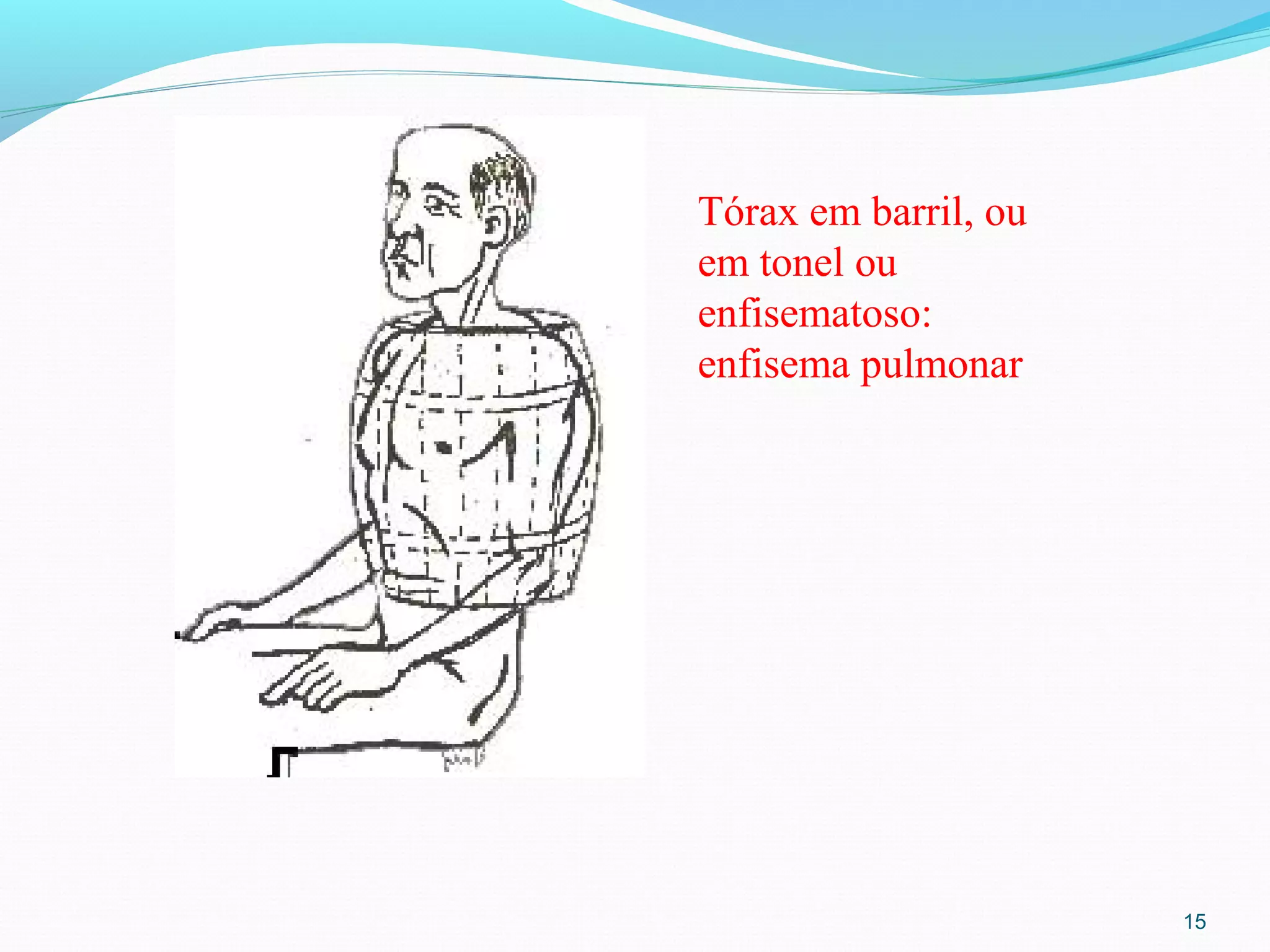 15
Tórax em barril, ou
em tonel ou
enfisematoso:
enfisema pulmonar
 