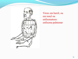 15
Tórax em barril, ou
em tonel ou
enfisematoso:
enfisema pulmonar
 