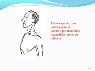 16
Tórax raquítico, em
quilha (peito de
pombo): por distúrbios
metabólicos sérios da
infância
 
