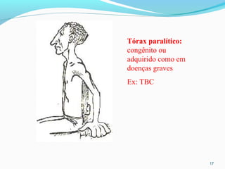 17
Tórax paralítico:
congênito ou
adquirido como em
doenças graves
Ex: TBC
 