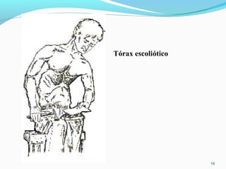19
Tórax escoliótico
 